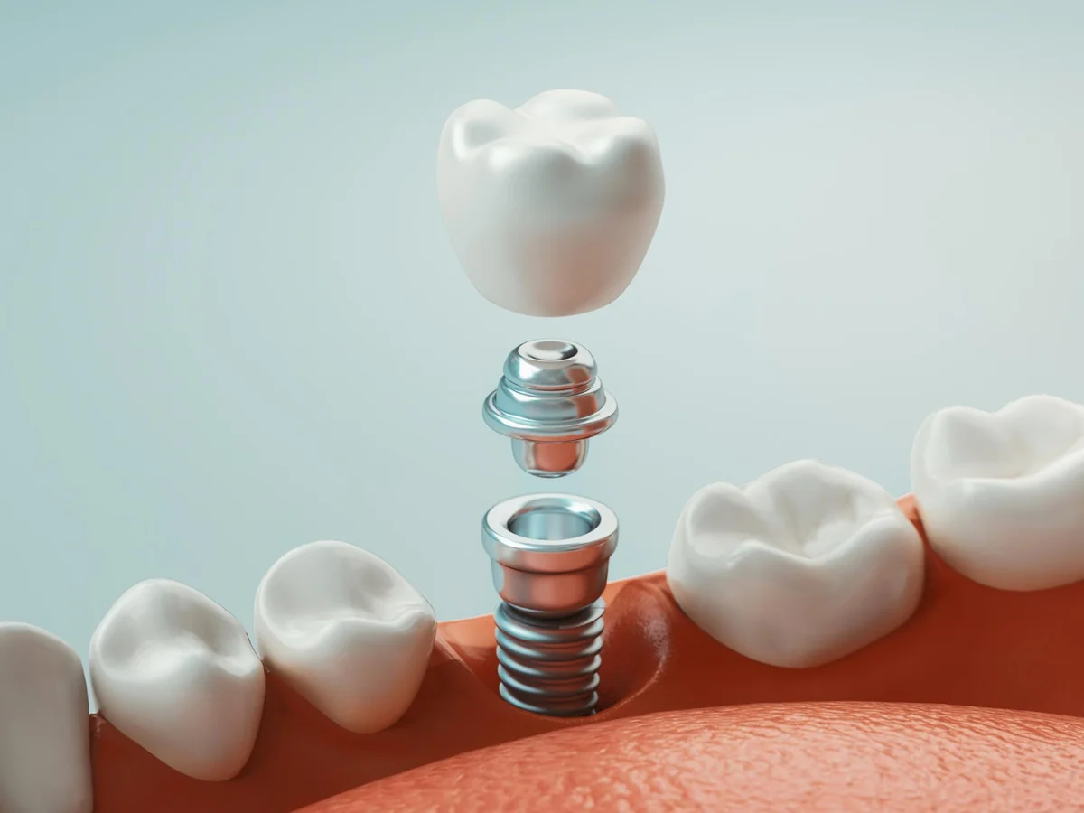 Fájdalommentes fogászati implantátum